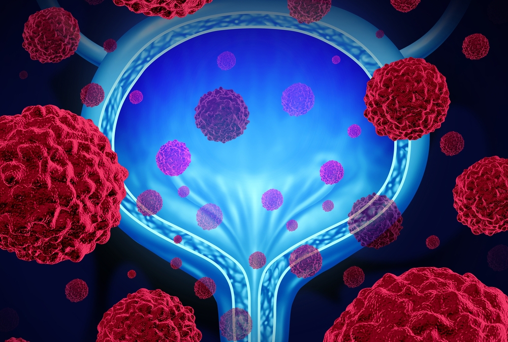 Urothelial Cancer Treatment Market Forecast, Analysis | Reports and Insights | 2024-2032